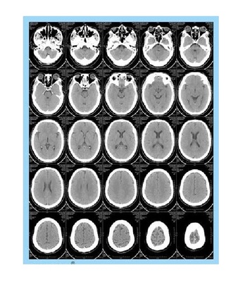 14”8 10 14 inch dry X-ray Thermal film, PET film for Agfa 5302 Fuji drypix 2000 3500 lite printers