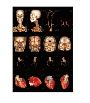 Hospital DR CR CT MRI DSA dry Thermal X-ray film, PET films for Agfa 5302 Fuji drypix 2000 3500 lite