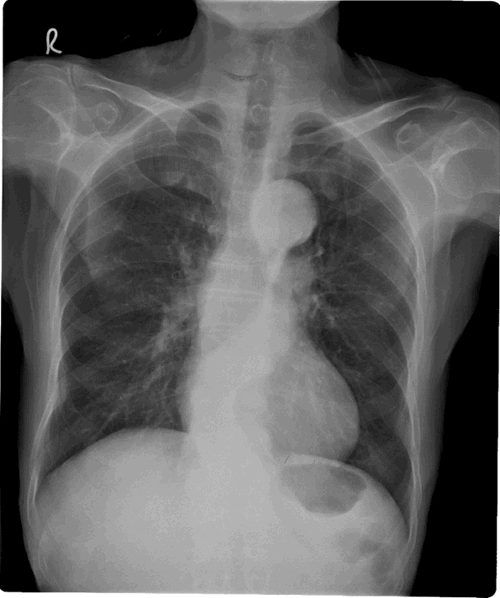 Enhanced X-Ray Zenith X10-F digital thermal printing Dry films for AFGA Drystar, Fuji Drypix 1000
